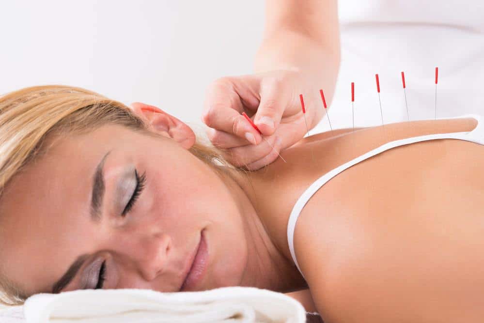 a young woman undergoing acupuncture healing